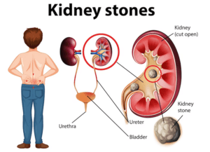 Can Massage Therapy Help Dislodge Kidney Stones? Exploring the Facts 2 Can a Massage Dislodge a Kidney Stone