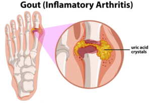 Does Foot Massage Help Gout? Symptoms and Management 2 Does Foot Massage Help Gout