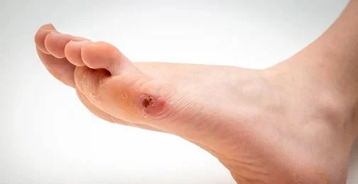 Can You Get a Foot Massage if You Have a Wart? 18 Can You Get a Foot Massage if You Have a Wart?