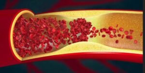 Can you massage a blood clot away